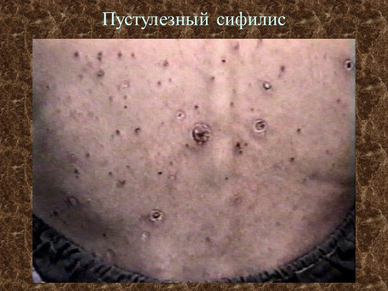 Пустулезный сифилис